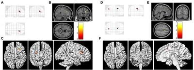 Examination of brain area volumes based on voxel-based morphometry and multidomain cognitive impairment in asymptomatic unilateral carotid artery stenosis